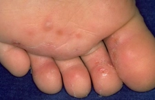 Ayak Mantarı Çeşitleri Nelerdir? Ayak Mantarı Çeşitleri Nelerdir?