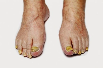 Tırnak Mantarına Bitkisel Çözüm Yöntemleri Tırnak Mantarına Bitkisel Çözüm Yöntemleri